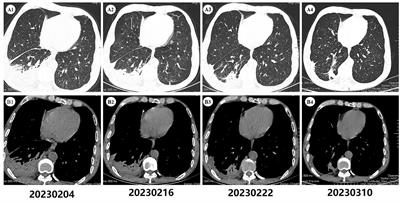 Case report: Rare pulmonary fungal infection caused by Penicillium digitatum: the first clinical report in China